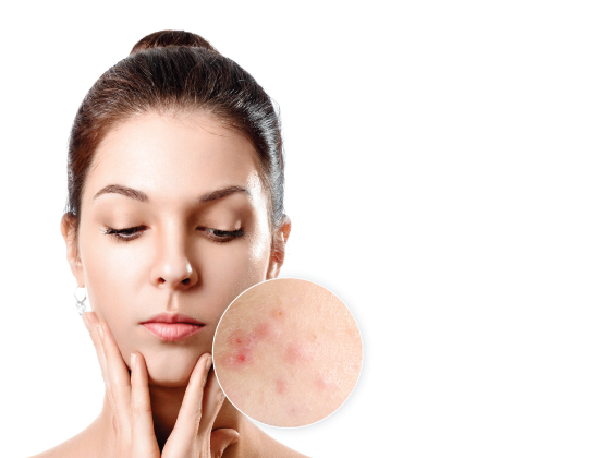 best-acne-treatment-kanyaa-skin-clinic-sr.nagar-hyderabad